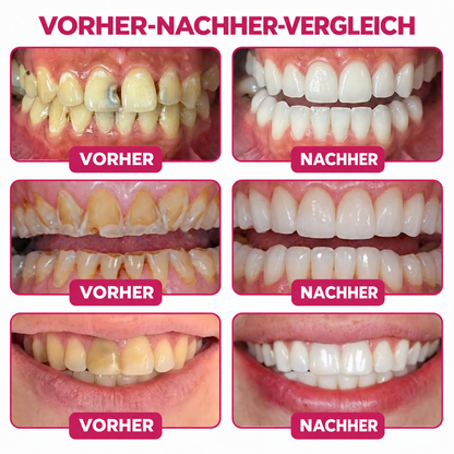 ✨👍Keyess® DenPerm🎉 — Gel zur natürlichen Zahnschmelzpflege bei Karies, empfindlichen Zähnen und geschwächtem Zahnschmelz