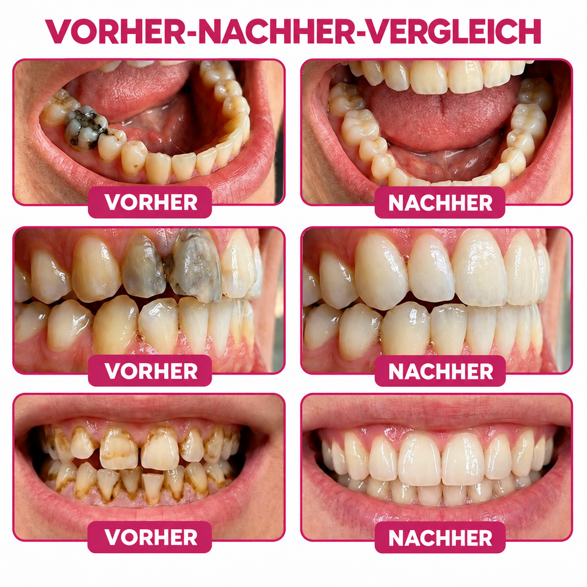 ✨👍Keyess® DenPerm🎉 — Gel zur natürlichen Zahnschmelzpflege bei Karies, empfindlichen Zähnen und geschwächtem Zahnschmelz