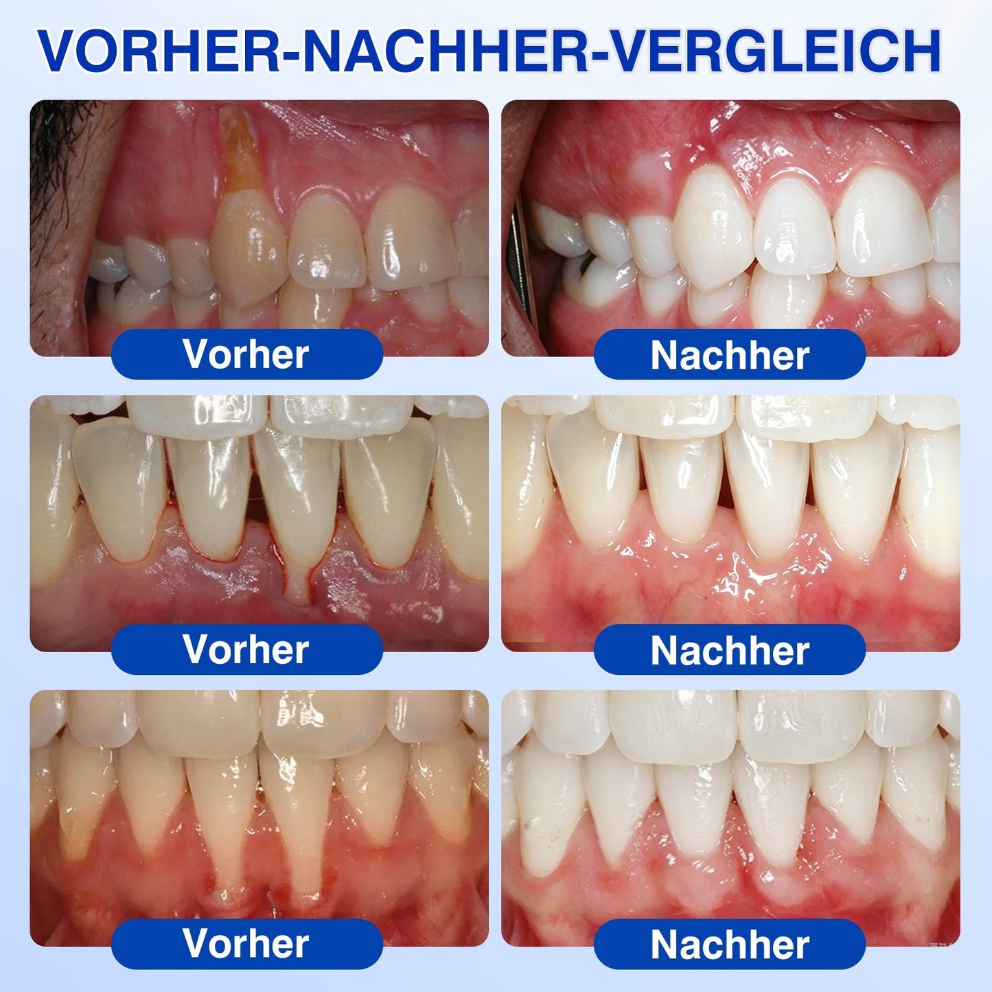 💥𝑲𝒆𝒚𝒆𝒔𝒔®🦷𝑮𝒖𝒎𝑹𝒆𝒗𝒊𝒗𝒆 𝑷𝒂𝒓𝒐𝒅𝒐𝒏𝒕𝒂𝒍𝒆𝒔 𝑹𝒆𝒑𝒂𝒓𝒂𝒕𝒖𝒓𝒈𝒆𝒍