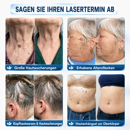 👩‍⚕️🎉𝑶𝒇𝒇𝒊𝒛𝒊𝒆𝒍𝒍𝒆𝒓 𝑺𝒕𝒐𝒓𝒆 | 𝑵𝐞𝒌𝐢𝐬𝐬® 🌿 𝑴𝒊𝒌𝒓𝒐𝒏𝒂𝒅𝒆𝒍𝒏 𝑴𝒂𝒌𝒆𝒍𝒍𝒐𝒔𝒆 𝑯𝒂𝒖𝒕 𝑯𝒂𝒖𝒕 𝑾𝒂𝒓𝒛𝒆 𝑬𝒏𝒕𝒇𝒆𝒓𝒏𝒖𝒏𝒈 𝑷𝒇𝒍𝒂𝒔𝒕𝒆𝒓 (𝐹ü𝑟 𝐻𝑎𝑢𝑡𝑎𝑛ℎä𝑛𝑔𝑠𝑒𝑙, 𝑘𝑙𝑒𝑖𝑛𝑒 𝐻𝑎𝑢𝑡𝑤𝑢𝑐ℎ𝑒𝑟𝑢𝑛𝑔𝑒𝑛, 𝑊𝑎𝑟𝑧𝑒𝑛, 𝑀𝑢𝑡𝑡𝑒𝑟𝑚𝑎𝑙𝑒, 𝐴𝑙𝑡𝑒𝑟𝑠𝑓𝑙𝑒𝑐𝑘𝑒𝑛 𝑢𝑛𝑑 𝑃𝑖𝑔𝑚𝑒𝑛𝑡𝑠𝑡ö𝑟𝑢𝑛𝑔𝑒𝑛.)